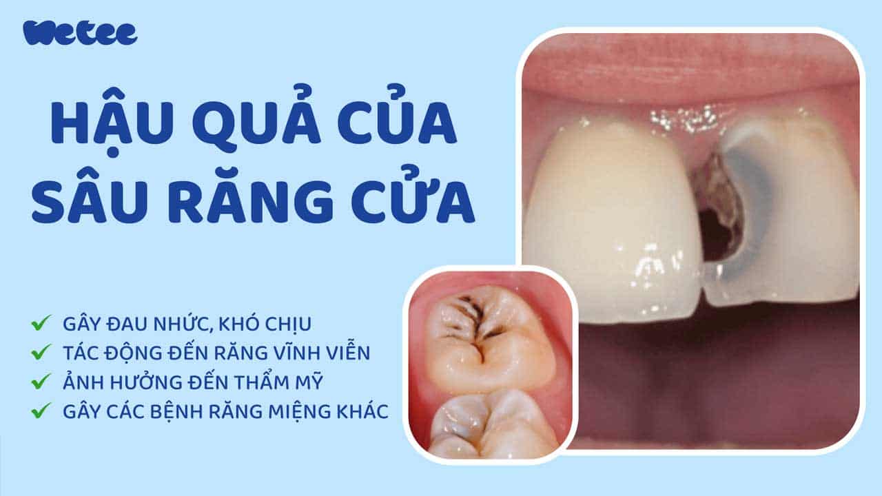 Sâu răng cửa có ảnh hưởng gì đến răng vĩnh viễn của con?